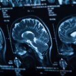 coup and contrecoup brain injuries