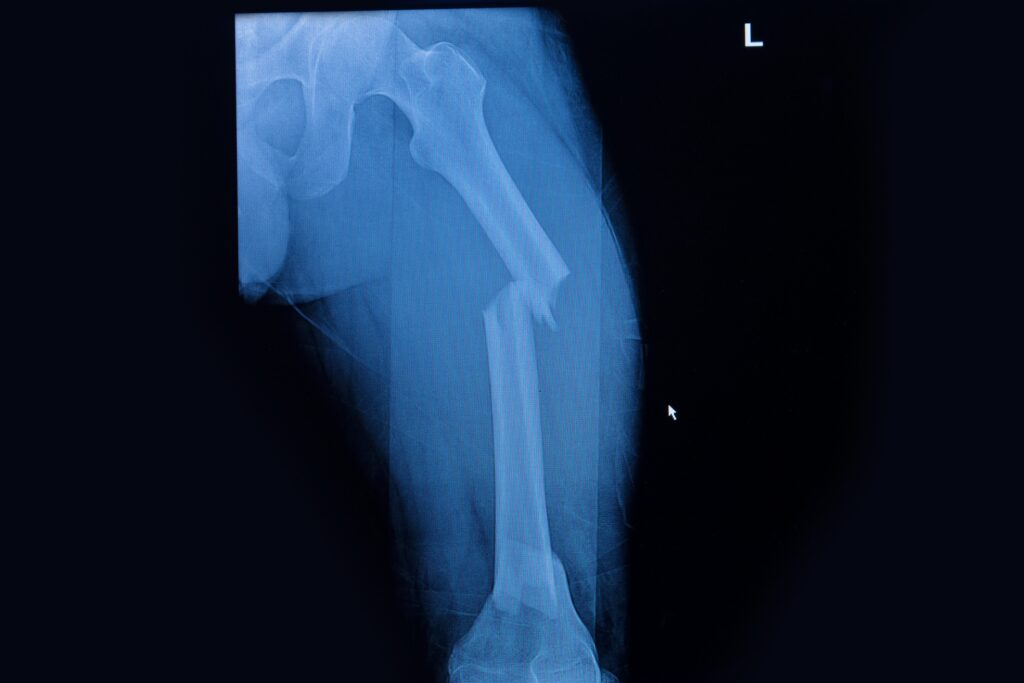 Kansas City Bone Fractures Lawyer