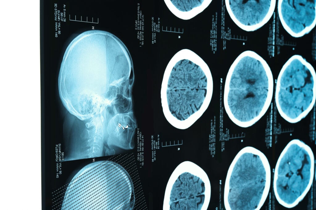 Topeka Brain Injury Lawyer