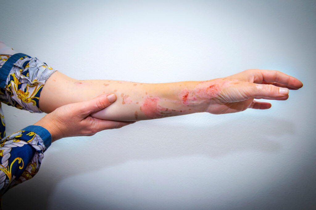 Topeka Burn Injuries Lawyer