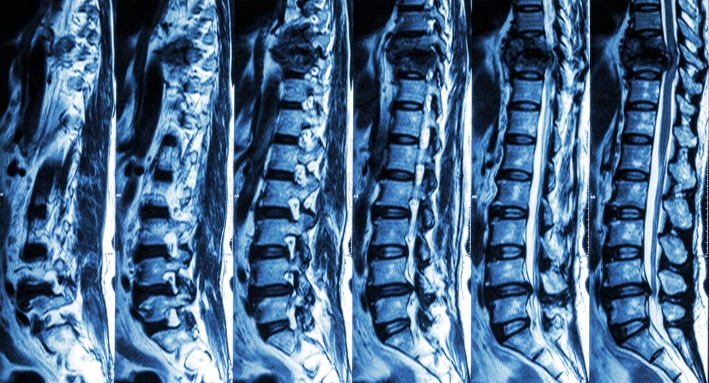 Topeka Spine Injury Attorney