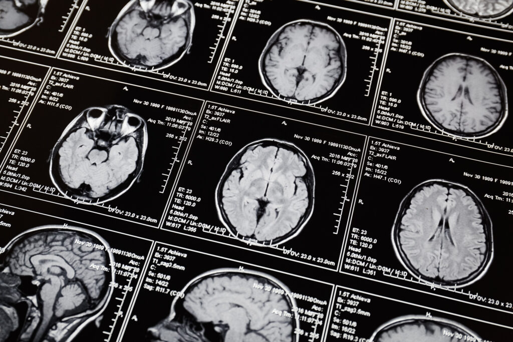 Wichita Brain Injury Lawyer
