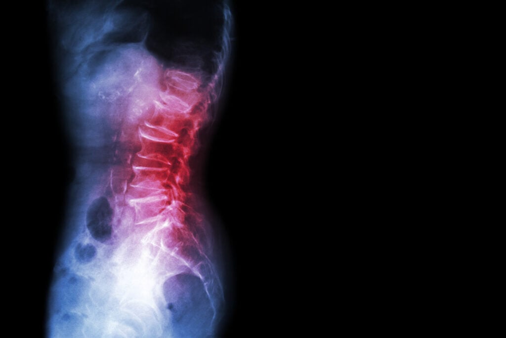 Wichita Spine Injury Attorney